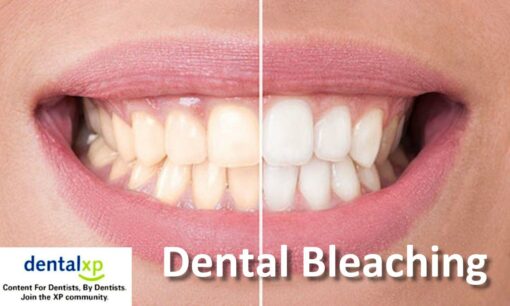 DentalXP Dental Bleaching