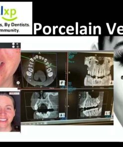 DentalXP Porcelain Veneers