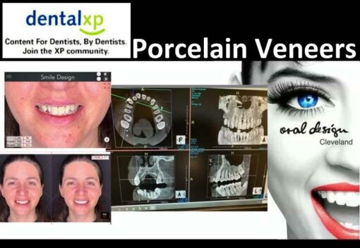 DentalXP Porcelain Veneers