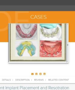gIDE ondemand lectures - Edentulous Patient Implant Placement and Restoration