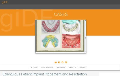 gIDE ondemand lectures - Edentulous Patient Implant Placement and Restoration