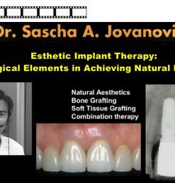 Esthetic Implant Therapy: Biological Elements in Achieving Natural Implants
