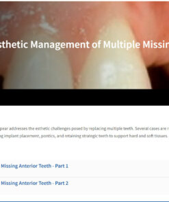 Classic Collection: Esthetic Management of Multiple Missing Anterior Teeth