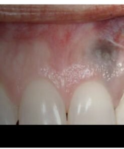 Gingival Levels