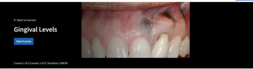 Gingival Levels