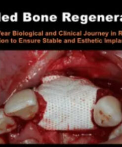 Guided Bone Regeneration: A 30 year Biological and Clinical Journey in Ridge Augmentation