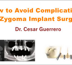 How to Avoid Complications in Zygoma Implant Surgery