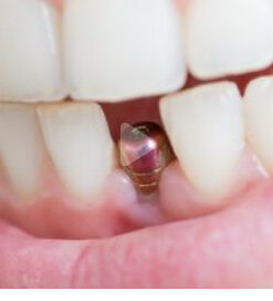 Classic Collection: Immediate Single Tooth Anterior Implants