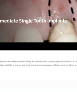 Classic Collection: Immediate Single Tooth Implants