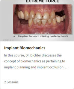 Implant Biomechanics