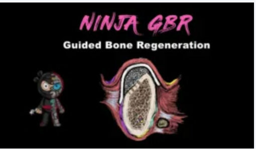 Implant Ninja, Guided Bone Regeneration