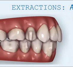 Invisalign and Extractions