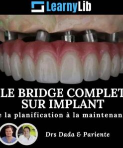 LearnyLib Le Bridge Complet sur Implant - Dada, Pariente de la plantification a la maintenance