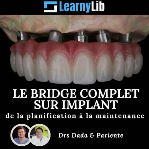 LearnyLib Le Bridge Complet sur Implant - Dada, Pariente de la plantification a la maintenance