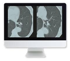 Lung Cancer Screening: A Comprehensive Guide Online Course
