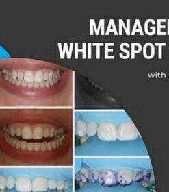 Management of White Spot Lesions