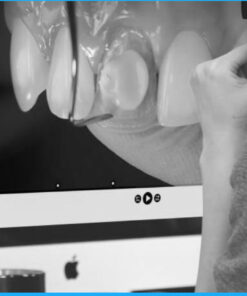 Masking the Dark Tooth with Direct Resin