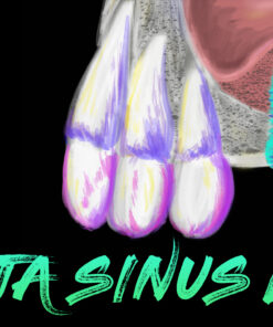 Implant Ninja Introduces Sinus Lifting Master