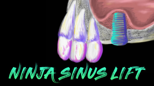 Implant Ninja Introduces Sinus Lifting Master