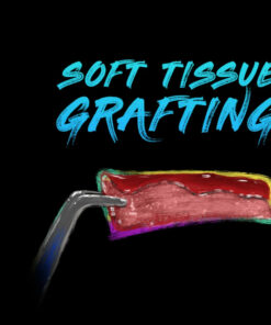 Ninja Soft Tissue Grafting