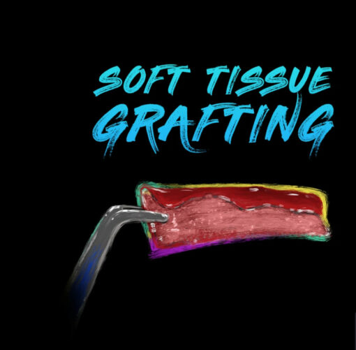 Ninja Soft Tissue Grafting