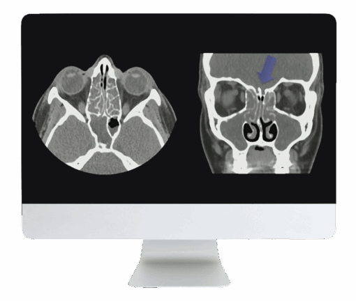 ARRS Cranial Nerve Imaging: From the Least to the Last 2022 ( Videos + CME Questions)