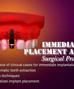 OHI-S Immediate Implant Placement and Loading Surgical Protocols
