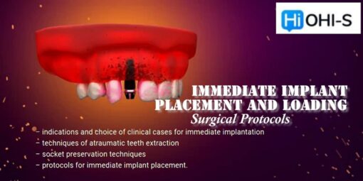 OHI-S Immediate Implant Placement and Loading Surgical Protocols