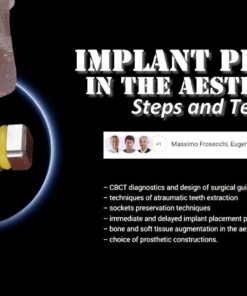 OHI-S Implant Placement in the Aesthetic Zone: Steps and Technique