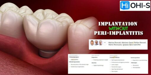 OHI-S Implantation Without Peri-Implantitis