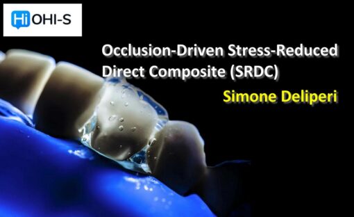 OHI-S Occlusion-Driven Stress-Reduced Direct Composite (SRDC) - Simone Deliperi