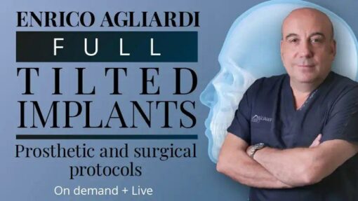 Osteocom Full Tilted Implants Prosthetic and Surgical Protocols