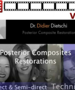 Posterior Composites Restorations: Direct & Semi-Direct Techniques