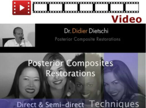 Posterior Composites Restorations: Direct & Semi-Direct Techniques