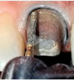 Classic Collection: Preparing Anterior Esthetic Crowns