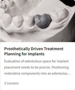 Prosthetically Driven Treatment Planning for Implants