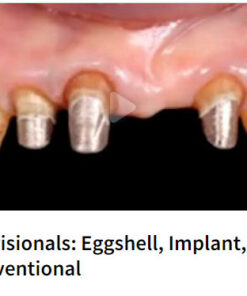 Provisionals: Eggshell, Implant, Conventional