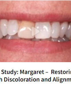 Case Study: Margaret –  Restoring Tooth Discoloration and Alignment
