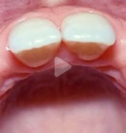 Classic Collection: Single Tooth Anterior Implants
