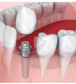 Classic Collection: Single Tooth Anterior Implants