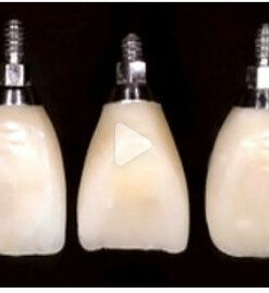 Classic Collection: Single Tooth Implant Temporaries