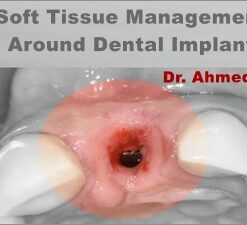 Soft Tissue Management Around Dental Implant, a Novel Approach