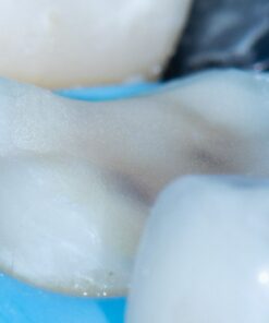The Baard Institute Overlay, Onlay, & Advanced Adhesion