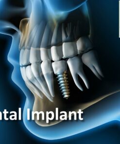 The Dental Vortex - Dental Implant