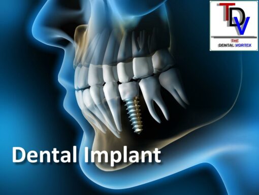 The Dental Vortex - Dental Implant