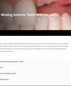 Treating Multiple Missing Anterior Teeth With Implants