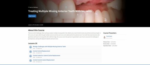 Treating Multiple Missing Anterior Teeth With Implants