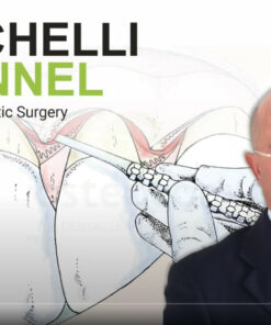 Vertical Advanced Flap (VAF) with simultaneous CTG on 31 and 41
