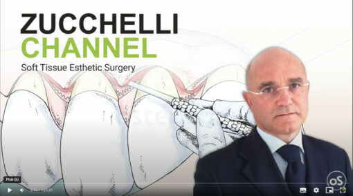 Vertical Advanced Flap (VAF) with simultaneous CTG on 31 and 41