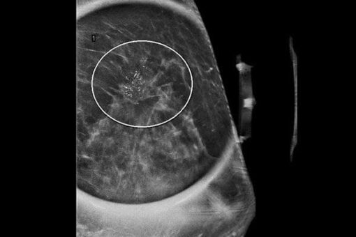 Imaging Mastery Series: High Risk Screening Breast MRI 2021 cme videos